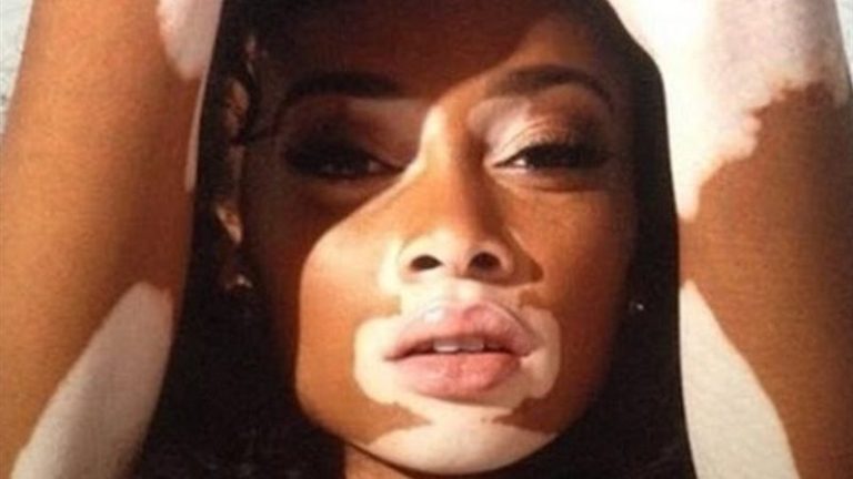 في اليوم العالمي للبهاق.. فئات أكثر عرضة للإصابة به وهذه أسبابه