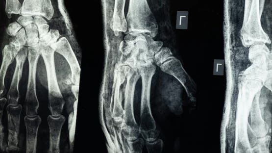 ابتكار صيني لعلاج الكسور في 3 دقائق