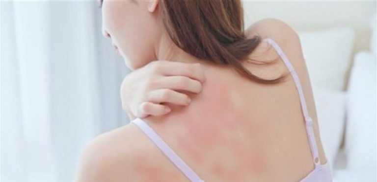 هذه الأمراض الجلدية تتفاقم في الخريف والشتاء!